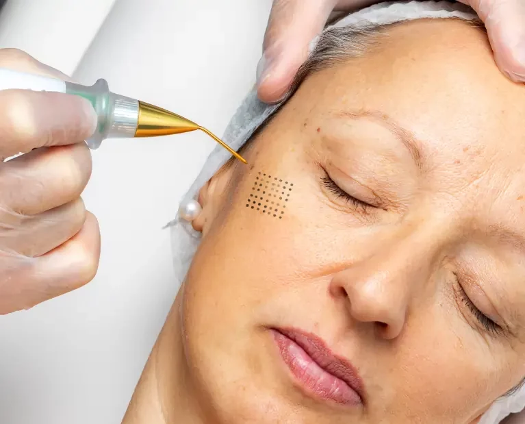Plasmapen Anti-Aging Behandlung in Mannheim - Gtastyy Kosmetikstudio